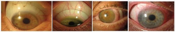Гипоксические осложнения роговицы глаз при ношении линз