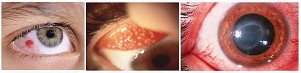Воспаления и инфекция глаз во от ношения линз